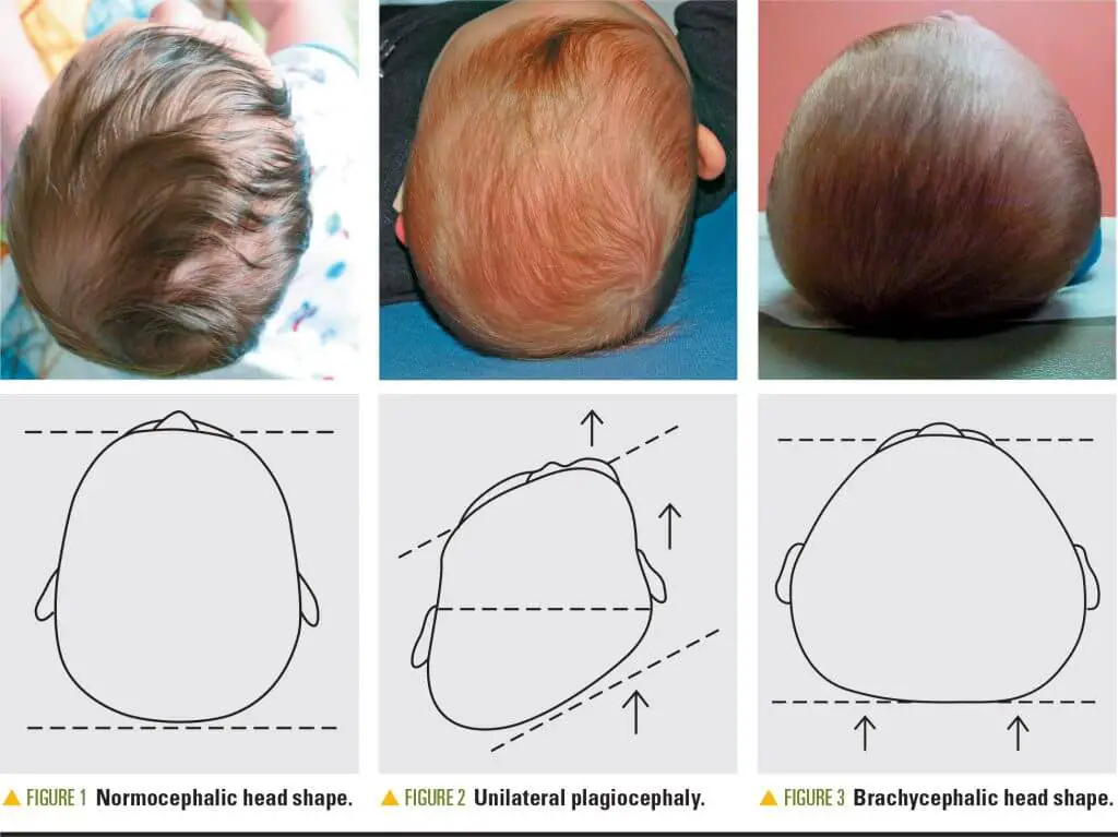 Plagiocephaly conditions can be healed with baby infant pillow.